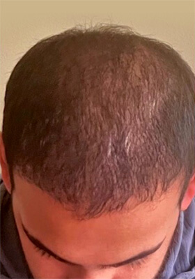 hair transplant photos