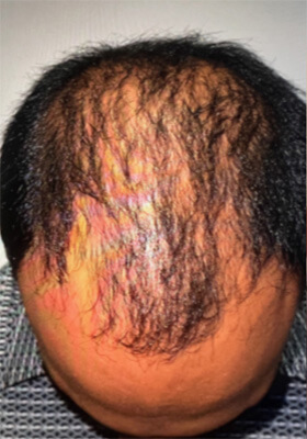 hair transplant photos