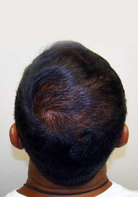 hair transplant photos