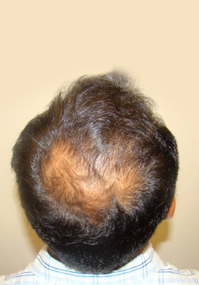 hair transplant photos