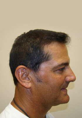 hair transplant photos