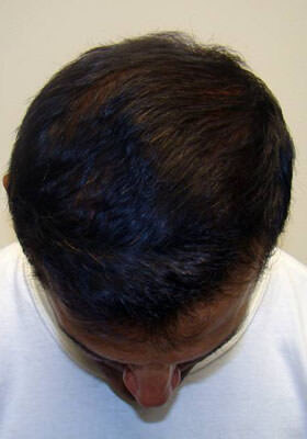 hair transplant before after Photos