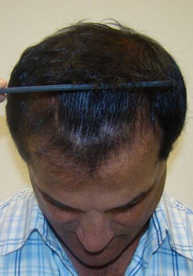 hair transplant photos