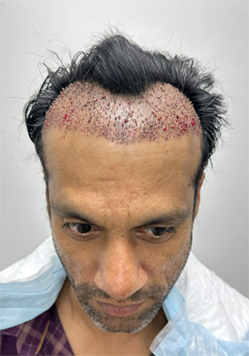 hair transplant photos