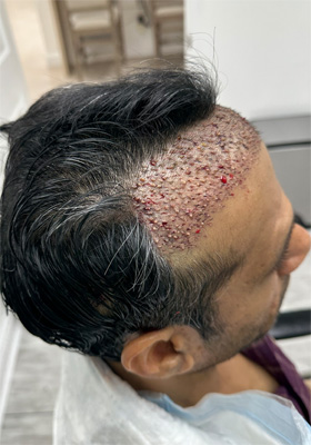 hair transplant photos