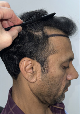 hair transplant photos