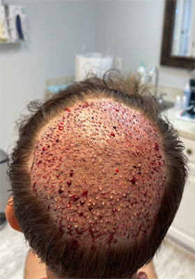 hair transplant photos