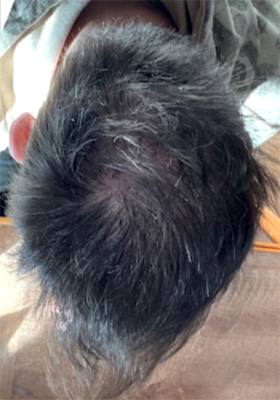 hair transplant photos