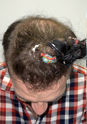 hair transplant photos