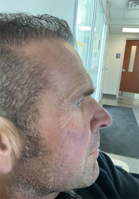 hair transplant photos