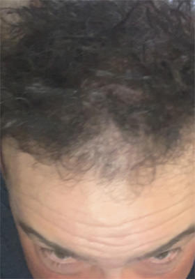 hair transplant photos