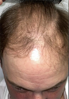 hair transplant photos