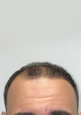 hair transplant photos