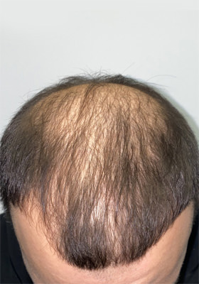 hair transplant before after Photos