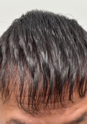 hair transplant photos