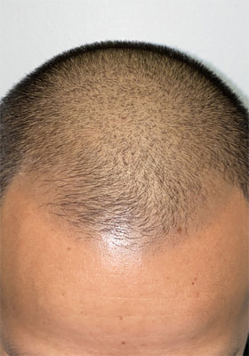 hair transplant photos