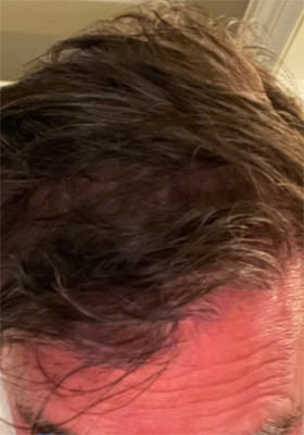 hair transplant photos