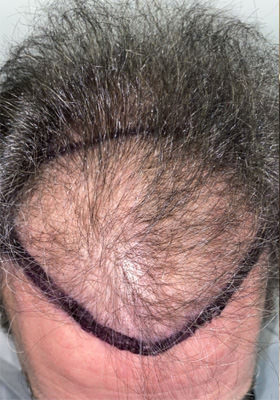 hair transplant before after Photos