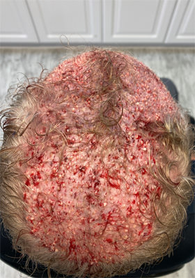 hair transplant photos