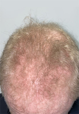 hair transplant photos