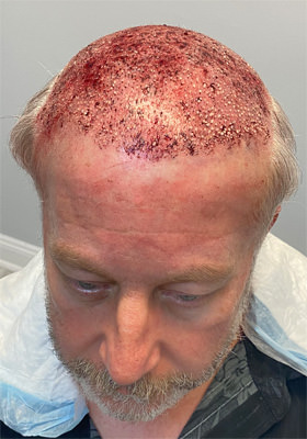 hair transplant photos