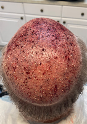 hair transplant photos