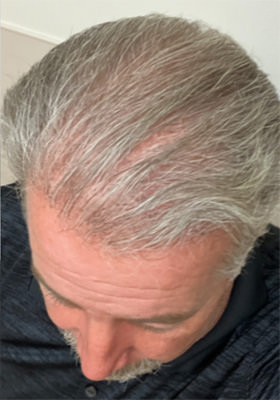 hair transplant before after Photos