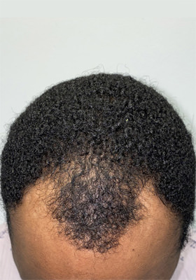 hair transplant photos