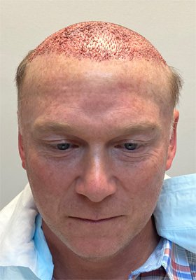 hair transplant photos