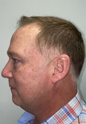 hair transplant photos