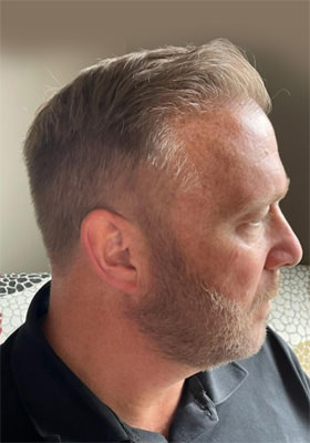 hair transplant photos