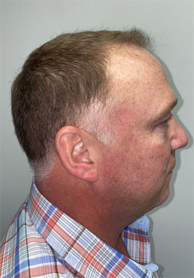 hair transplant photos