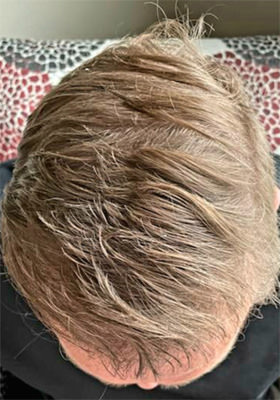 hair transplant photos