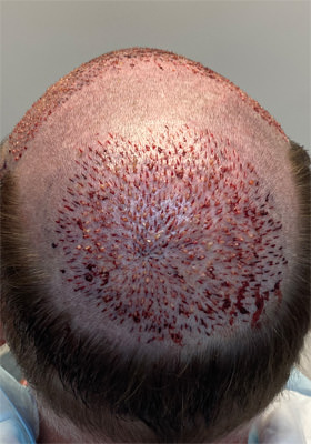 hair transplant photos