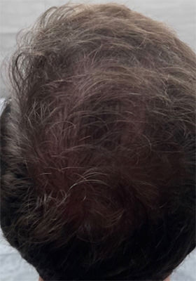 hair transplant before after Photos