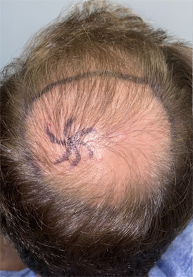 hair transplant before after Photos