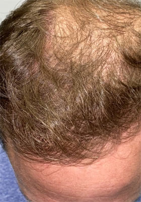 hair transplant before after Photos