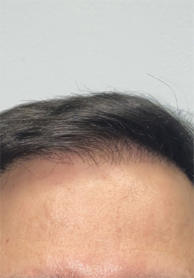 hair transplant before after Photos