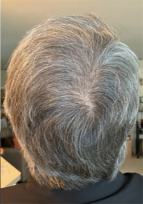 hair transplant before after Photos