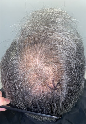 hair transplant photos