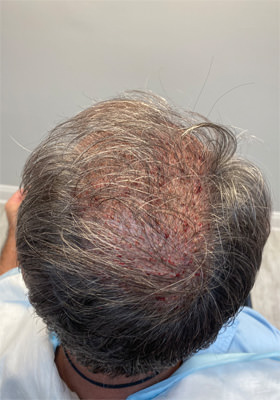 hair transplant photos