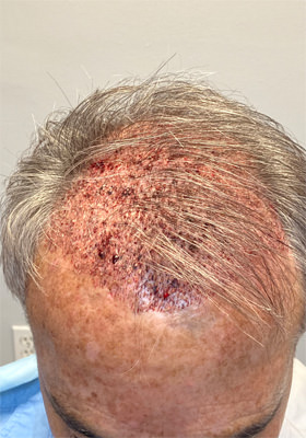 hair transplant photos