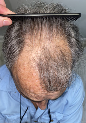 hair transplant photos