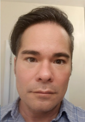 hair transplant photos