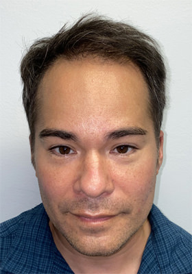 hair transplant photos