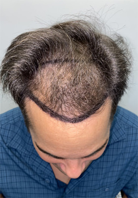 hair transplant photos