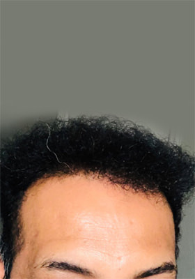 hair transplant before after Photos