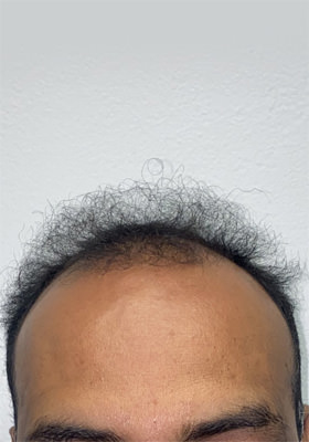 hair transplant photos