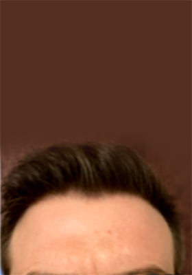 hair transplant photos