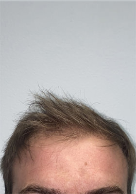 hair transplant before after Photos